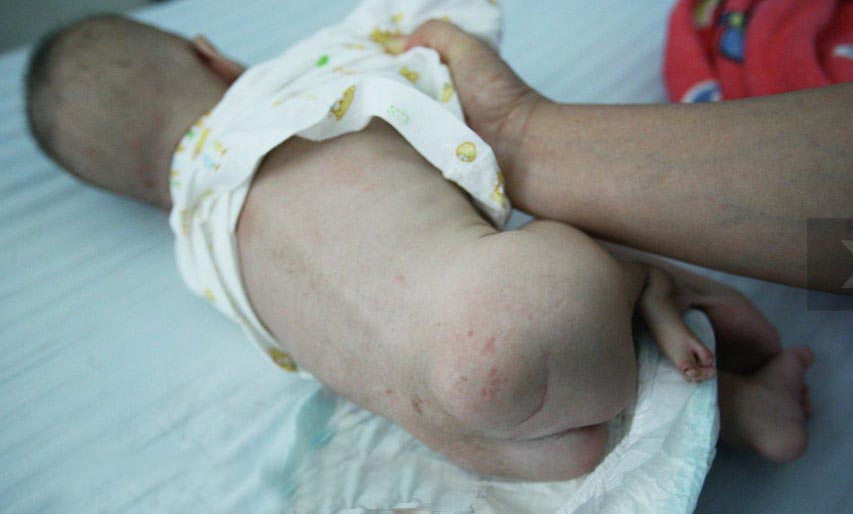 奇闻：三条腿女婴 遭父母遗弃（图）